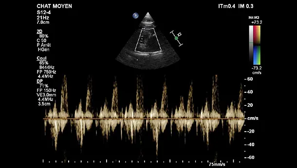 Echographie cardique